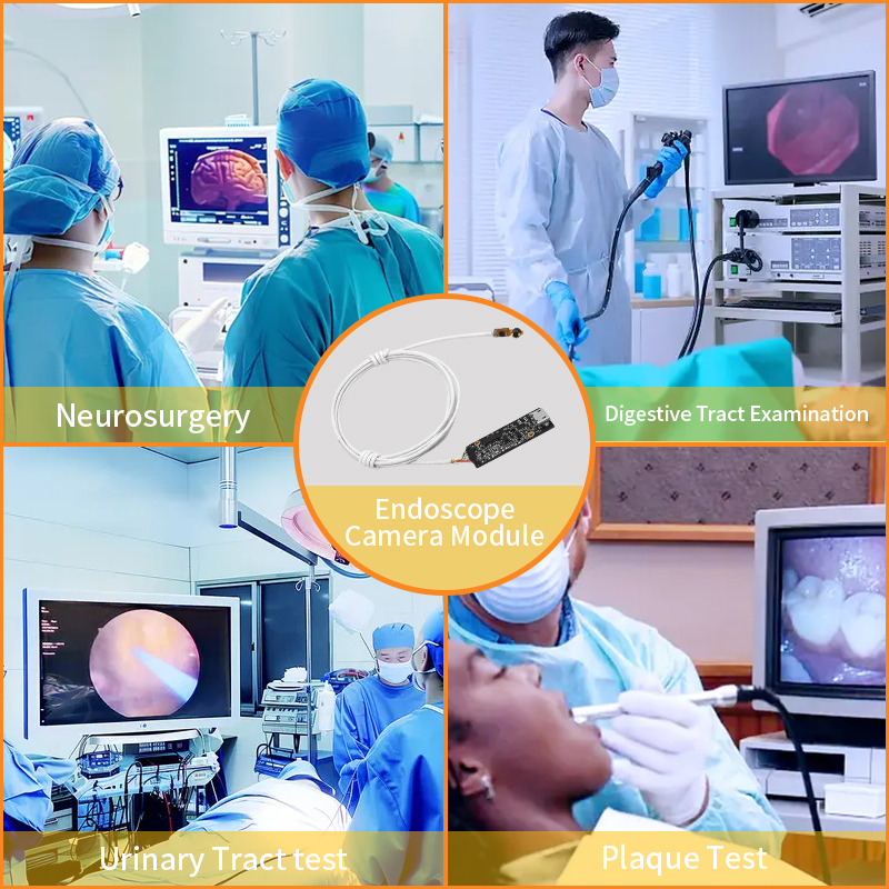 Avantages d'application de base du module de cam&eacute;ra endoscopique dans la plate-forme chirurgicale